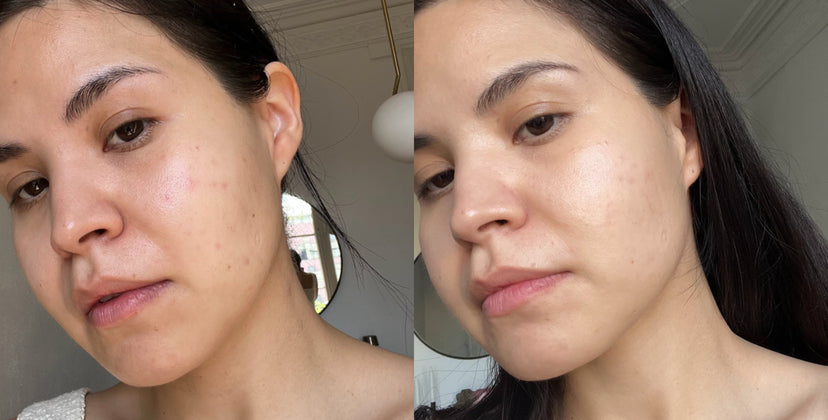 Niacinamide & Salicylic Acid For Breakout-Prone Skin